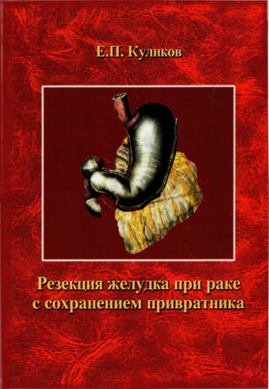 Резекция желудка при раке с сохранением привратника