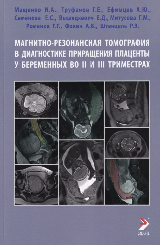 Магнитно-резонансная томография в диагностике приращения плаценты у беременных во II и III триместрах