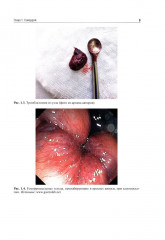 Атлас колопроктологических заболеваний - Фото 4