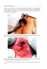 Атлас колопроктологических заболеваний - Фото 6