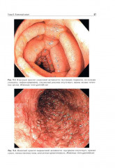 Атлас колопроктологических заболеваний - Фото 13