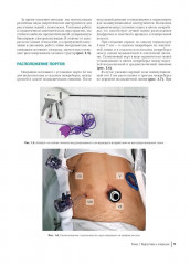 Атлас торакоскопических лобэктомий при злокачественных опухолях - Фото 5