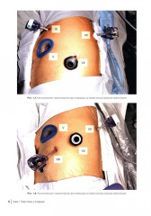 Атлас торакоскопических лобэктомий при злокачественных опухолях - Фото 6