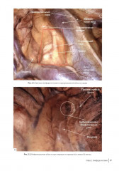 Атлас торакоскопических лобэктомий при злокачественных опухолях - Фото 9