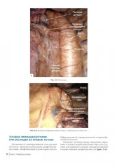 Атлас торакоскопических лобэктомий при злокачественных опухолях - Фото 10