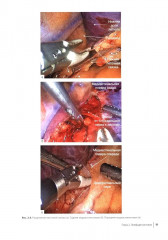 Атлас торакоскопических лобэктомий при злокачественных опухолях - Фото 11