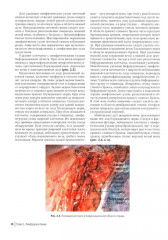 Атлас торакоскопических лобэктомий при злокачественных опухолях - Фото 12