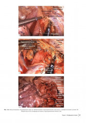 Атлас торакоскопических лобэктомий при злокачественных опухолях - Фото 13