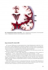 Микрохирургия сложных аневризм средних мозговых артерий: гигантских, фузиформных и частично тромбированных - Фото 5