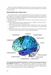 Микрохирургия сложных аневризм средних мозговых артерий: гигантских, фузиформных и частично тромбированных - Фото 6