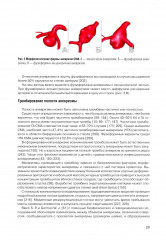 Микрохирургия сложных аневризм средних мозговых артерий: гигантских, фузиформных и частично тромбированных - Фото 15