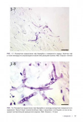 Гистологическая диагностика инвазивных микозов - Фото 3