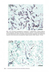 Гистологическая диагностика инвазивных микозов - Фото 13