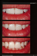 Эстетическая и реставрационная стоматология. Выбор материалов и методов - Фото 8