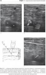 Справочник по интервенционным радиологическим процедурам - Фото 17