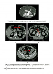 Диагностика и хирургическое лечение перитонеального канцероматоза - Фото 12
