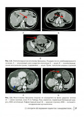Диагностика и хирургическое лечение перитонеального канцероматоза - Фото 13