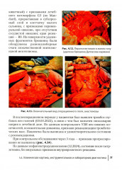 Диагностика и хирургическое лечение перитонеального канцероматоза - Фото 15