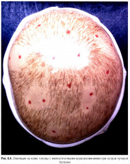 Судебно-медицинская экспертиза при радиационных поражениях - Фото 14