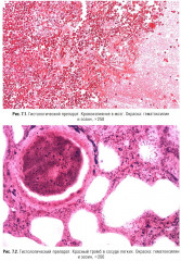 Судебно-медицинская экспертиза при радиационных поражениях - Фото 15