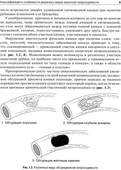 Кишечная непроходимость