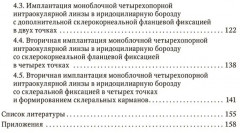 Склеральная фиксация интраокулярных линз от А до Я. Руководство для врачей - Фото 2