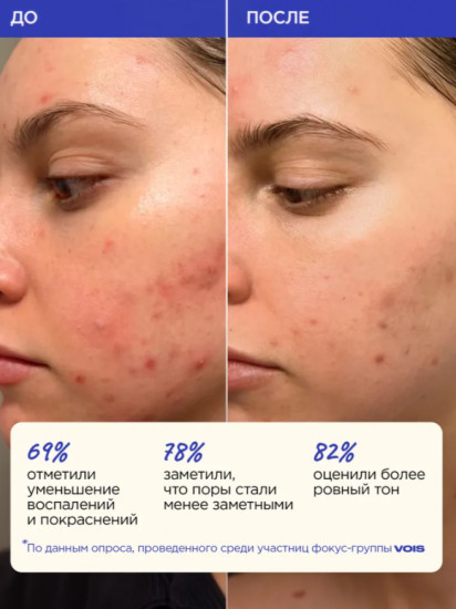 Сыворотка для лица с ниацинамидом для проблемной и комбинированной кожи