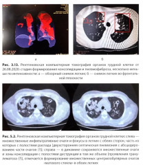 COVID-19 и постковидный синдром у больных ревматологического профиля - Фото 9
