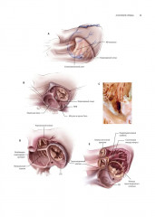 Кардиохирургия. Техника выполнения операций - Фото 4