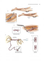 Кардиохирургия. Техника выполнения операций - Фото 6