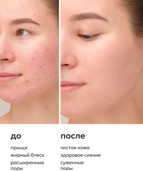 Сыворотка для лица против акне и прыщей