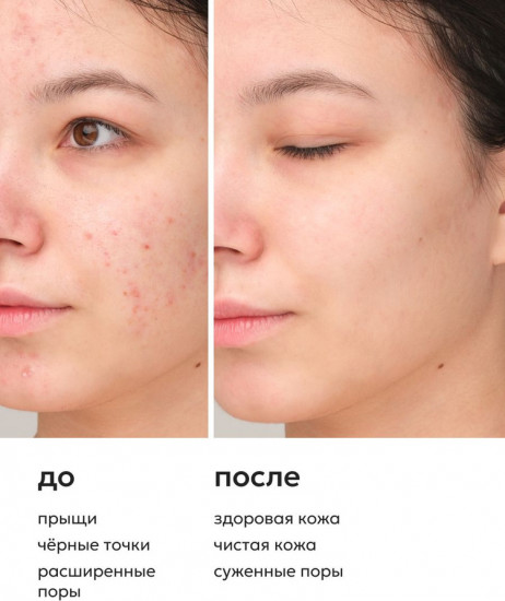 Пенка с ниацинамидом, цинком и салициловой кислотой