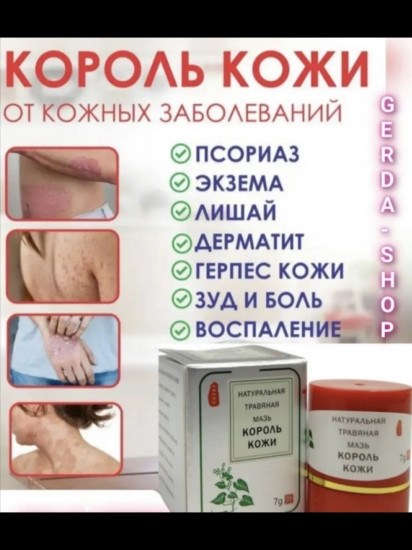 Натуральная травяная мазь «Король Кожи»