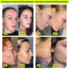 Патчи точечного нанесения от прыщей и акне с витамином С «Pow Patch Vitamin C Spot Patches» - Фото 10