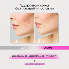 Патчи от прыщей точечные с салициловой кислотой - Фото 3