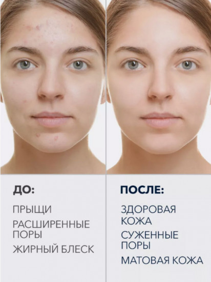 Пенка для лица с салициловой кислотой «Salicylic Acid Acne Removal Cleanser»