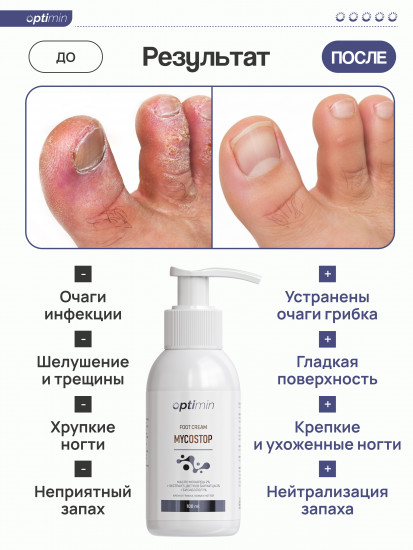 Крем от грибка для ног и рук