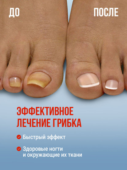 Крем противогрибковый, от грибка ног и ногтей