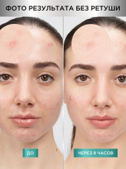 Патчи против прыщей гидроколлоидные невидимые «Pimple Patches Invisible» - Фото 1