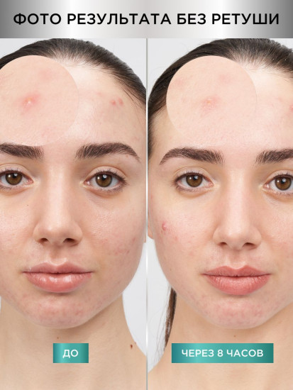 Патчи против прыщей гидроколлоидные невидимые «Pimple Patches Invisible»