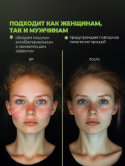 Крем от прыщей и угрей: борьба с акне и очищение пор - Фото 4
