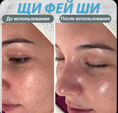 Крем для лица от прыщей и угрей - Фото 6