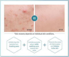 Крем для проблемной кожи лица - Фото 4