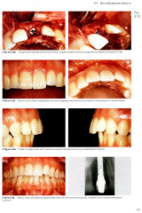 Имплантация в эстетически значимой зоне. Поэтапный алгоритм планирования лечения - Фото 5