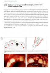 Имплантация в эстетически значимой зоне. Поэтапный алгоритм планирования лечения - Фото 6