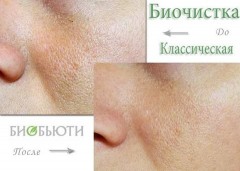 Биочистка для лица классическая - Фото 1