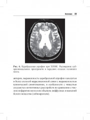 Хроническая цереброваскулярная недостаточность - Фото 6