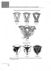 Лечение бесплодия при эндометриозе. Взгляд репродуктолога - Фото 10