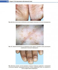 Дерматоскопия, трихоскопия и онихоскопия в педиатрической практике - Фото 9