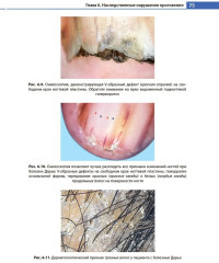 Дерматоскопия, трихоскопия и онихоскопия в педиатрической практике - Фото 10
